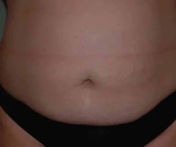 Before Abdominoplasty Female Patient Front Angle View Case 1497