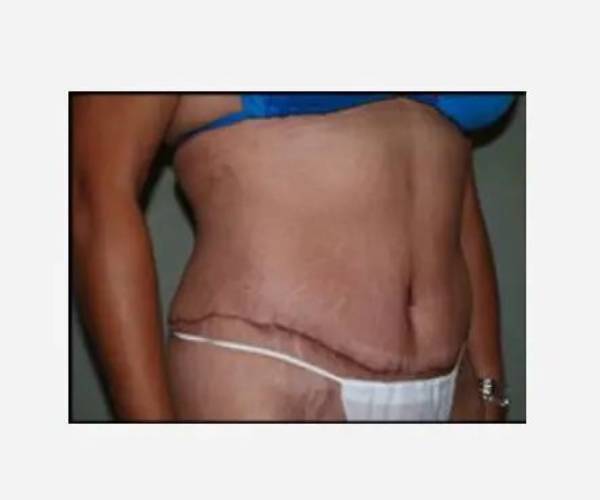 After Abdominoplasty Female Patient Diagonal Angle View Case 1497