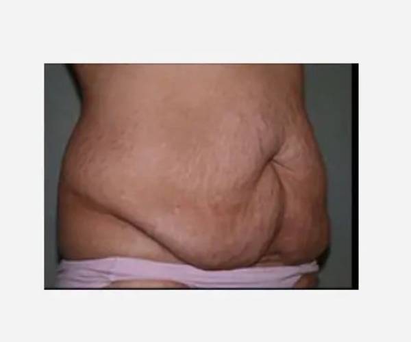 Before Abdominoplasty Female Patient Diagonal Angle View Case 1497