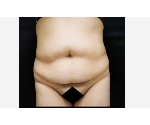 before tummy tuck front view female patient case 2616