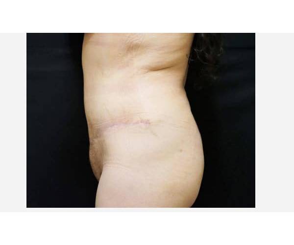 after tummy tuck side view female patient case 2616