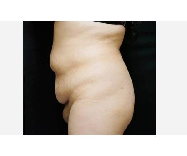 before tummy tuck side view female patient case 2616