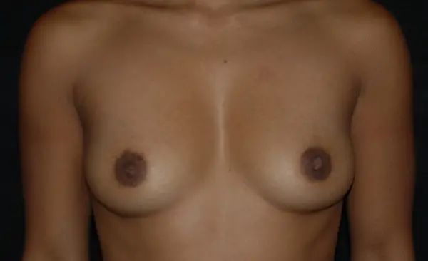 before front view breast augmentation female patient case 1874