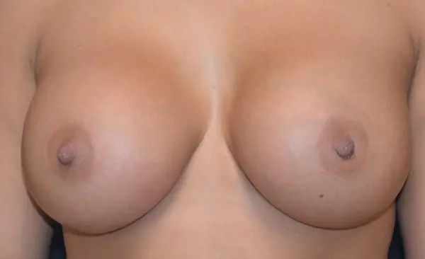 after front view breast augmentation female patient case 1885