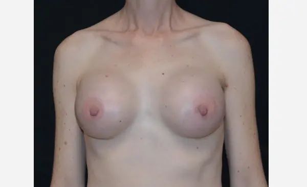 after front view breast augmentation male patient case 1907