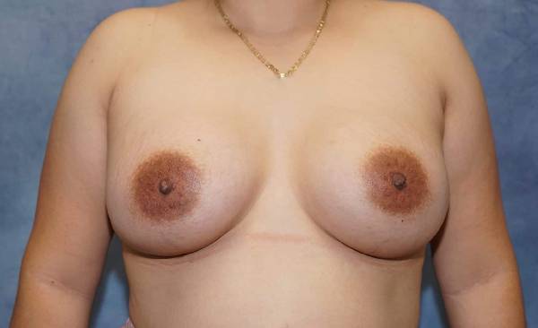 after breast augmentation front view female patient case 2159