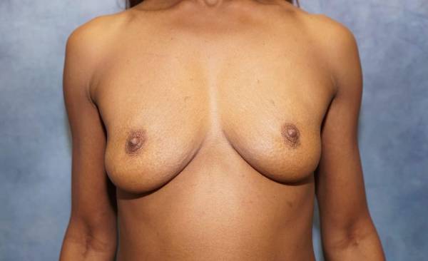 before breast augmentation front view female patient case 2164