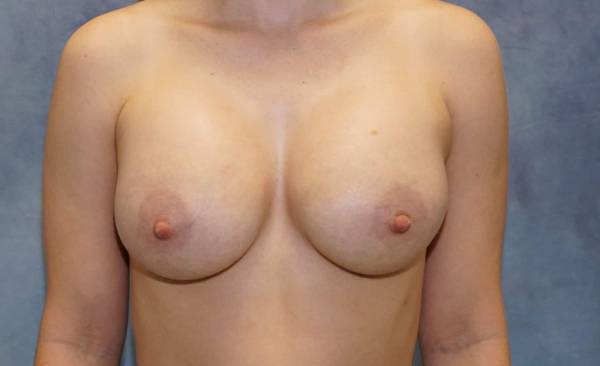 after breast augmentation front view female patient case 2182