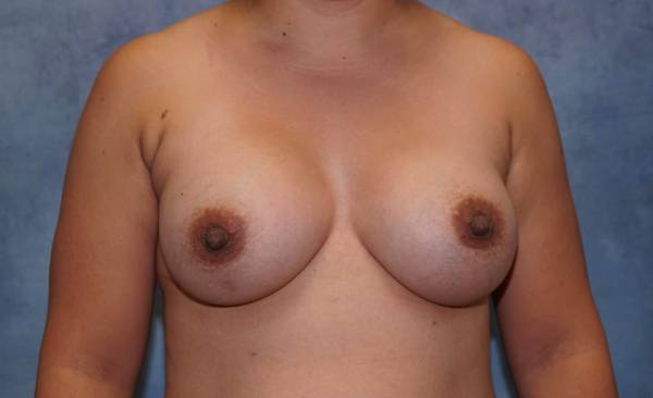 after breast augmentation front view female patient case 2187