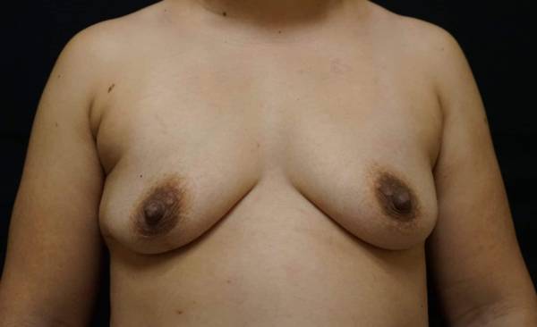 before breast augmentation front view female patient case 2187