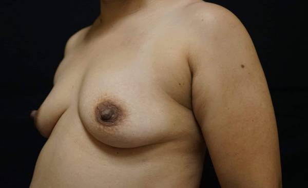 before breast augmentation left view female patient case 2187