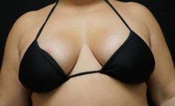 after breast augmentation front view case 2592