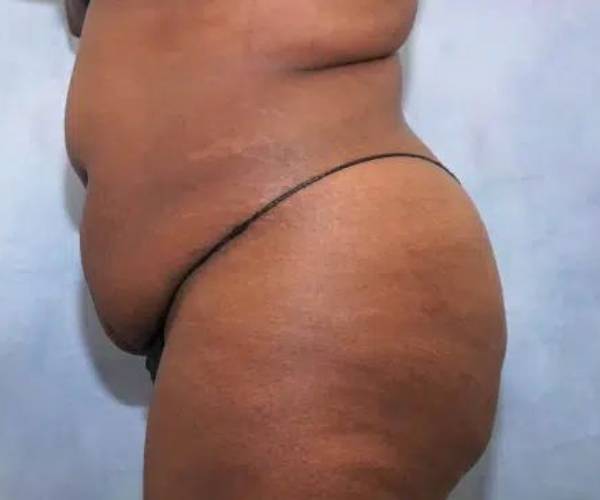 before left view butt lift female patient case 1763