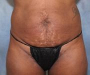 Before Lipo Abdominoplasty Female Patient Front Angle View Case 1224