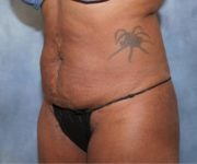 Before Lipo Abdominoplasty Female Patient Diagonal Angle View Case 1224