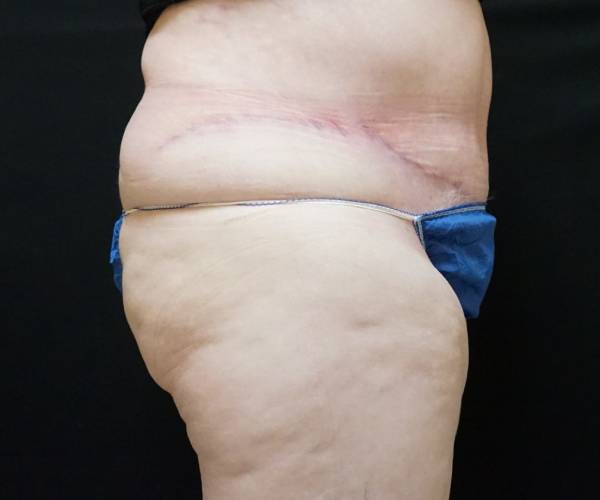 After Lipo Abdominoplasty Female Patient Right Side Angle View Case 1243