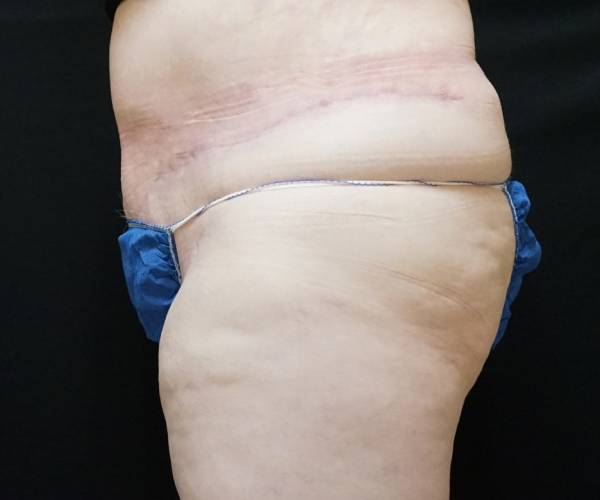 After Lipo Abdominoplasty Female Patient Left Side Angle View Case 1243