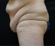 Before Lipo Abdominoplasty Female Patient Left Side Angle View Case 1243