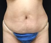 before tummy tuck front view female patient case 4203