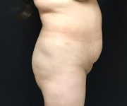 before tummy tuck side view female patient case 4203