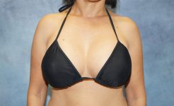 after breast augmentation front view case 5699