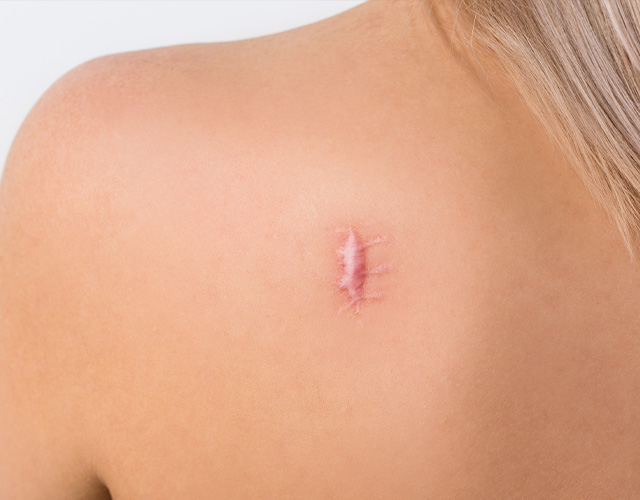 Keloid Treatment Las Vegas, NV