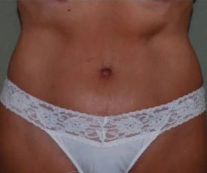 After Abdominoplasty Female Patient Front Angle View Case 1574