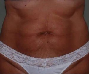 Before Abdominoplasty Female Patient Front Angle View Case 1574