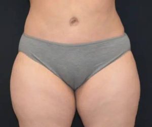 After Abdominoplasty Female Patient Front Angle View Case 1579