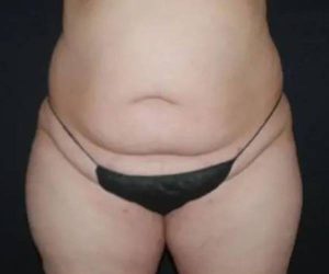 Before Abdominoplasty Female Patient Front Angle View Case 1579