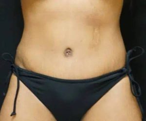 After Abdominoplasty Female Patient Front Angle View Case 1650