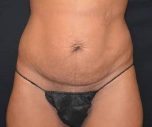 Before Abdominoplasty Female Patient Front Angle View Case 1650
