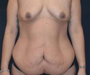 Before Abdominoplasty Female Patient Front Angle View Case 1663
