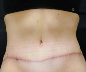 After Abdominoplasty Female Patient Front Angle View Case 1681