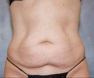 Before Abdominoplasty Female Patient Front Angle View Case 1681
