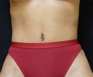 After Abdominoplasty Female Patient Front Angle View Case 1696