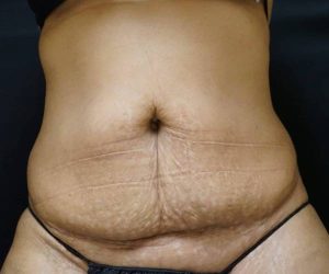 Before Abdominoplasty Female Patient Front Angle View Case 1696