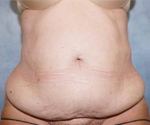 Before Abdominoplasty Female Patient Front Angle View Case 1718