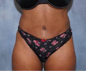 after front view abdominoplasty female patient case 1734