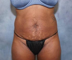 before front view abdominoplasty female patient case 1734