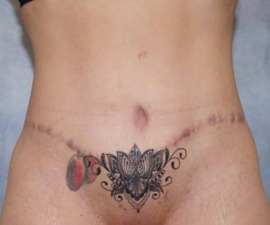 after front view abdominoplasty female patient case 1746