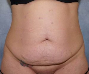before front view abdominoplasty female patient case 1746