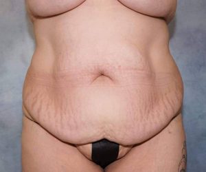 before tummy tuck front view female patient case 2564