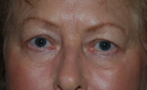 Before Blepharoplasty Female Patient Case 1348