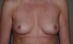 before front view breast augmentation female patient case 1809