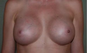 after front view breast augmentation female patient case 1809