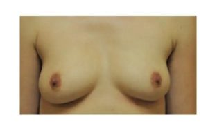 before front view breast augmentation female patient case 1812