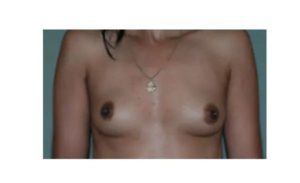 before front view breast augmentation female patient case 1818