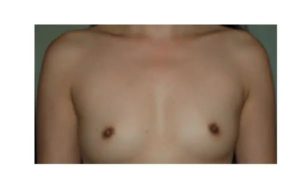 before front view breast augmentation female patient case 1821