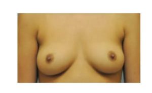 before front view breast augmentation female patient case 1835
